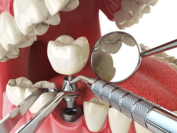 Best Emergency Treatment for Dental Infections or Abscesses in Phoenix Lake, CA